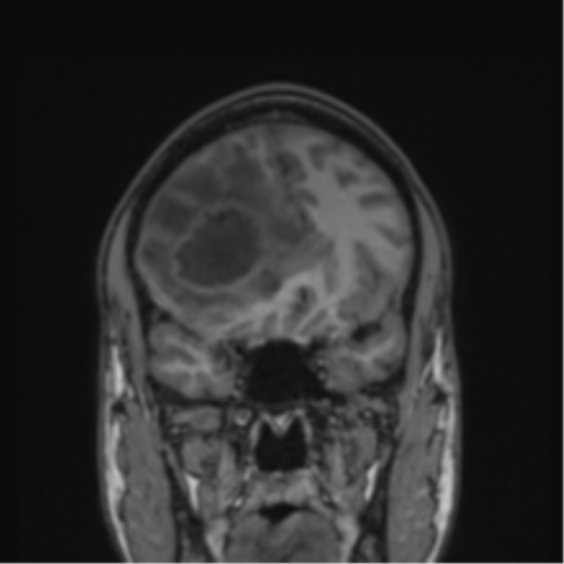 Cerebral abscess (Radiopaedia 60342-68009 Coronal T1 36).png