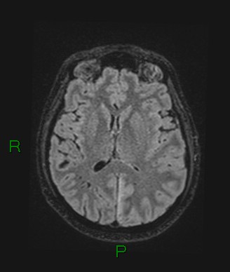 Cerebral abscess and subdural empyema (Radiopaedia 84436-99779 Axial FLAIR 40).jpg