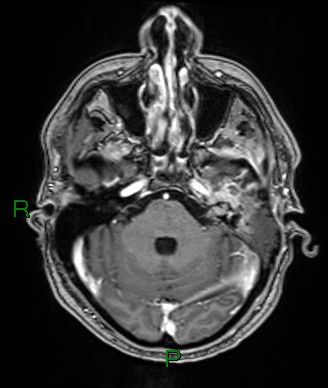 Cerebral abscess and subdural empyema (Radiopaedia 84436-99779 Axial T1 C+ 64).jpg