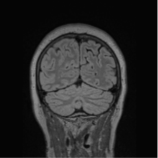Cerebral abscess from pulmonary arteriovenous malformation (Radiopaedia 86275-102291 Coronal FLAIR 22).png