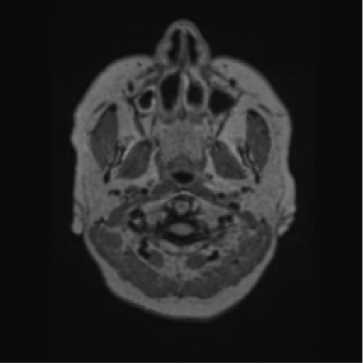 File:Cerebral abscess from pulmonary arteriovenous malformation (Radiopaedia 86275-102291 J 2).png