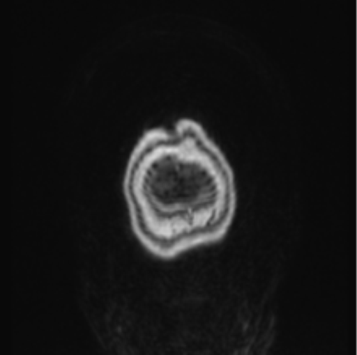 File:Cerebral abscess from pulmonary arteriovenous malformation (Radiopaedia 86275-102291 L 3).png