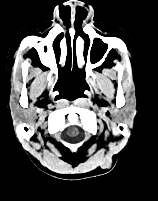 Cerebral abscesses (Radiopaedia 70458-80568 Axial non-contrast 9).jpg