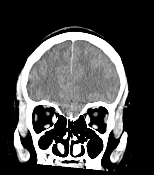Cerebral abscesses (Radiopaedia 70458-80568 Coronal Contrast 18).jpg
