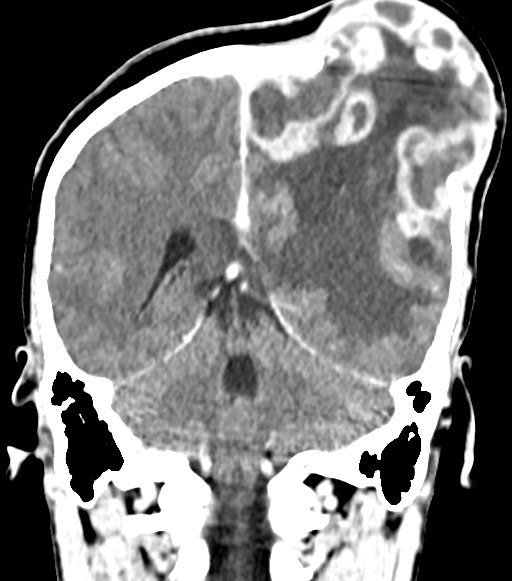 File:Cerebral abscesses (Radiopaedia 70458-80568 Coronal Contrast 44).jpg