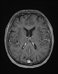 Cerebral amyloid angiopathy-related inflammation (Radiopaedia 58270-65377 Axial T1 C+ fat sat 85).jpg
