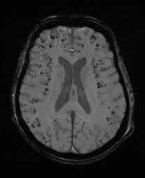 File:Cerebral amyloid angiopathy-related inflammation (Radiopaedia 74836-85849 Axial SWI 43).jpg