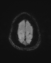 File:Cerebral amyloid angiopathy-related inflammation (Radiopaedia 74836-85849 Axial SWI 66).jpg