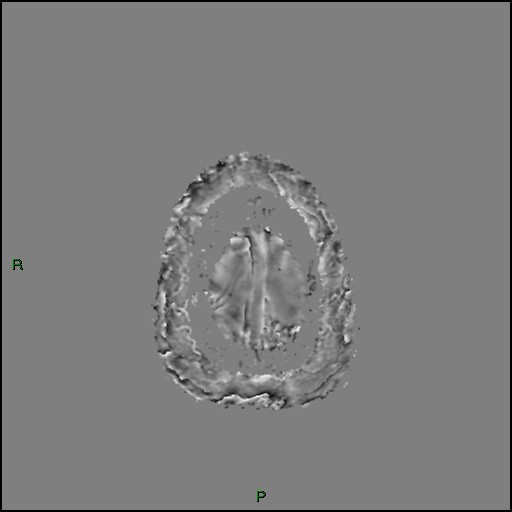 Cerebral amyloid angiopathy (Radiopaedia 77506-89664 H 97).jpg