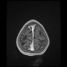 Cerebral and spinal tuberculosis (Radiopaedia 90489-107837 Axial T1 C+ 174).jpg