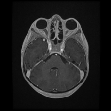 Cerebral and spinal tuberculosis (Radiopaedia 90489-107837 Axial T1 C+ 64).jpg