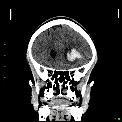 File:Cerebral arteriovenous malformation (AVM) (Radiopaedia 78162-90706 Coronal non-contrast 32).jpg