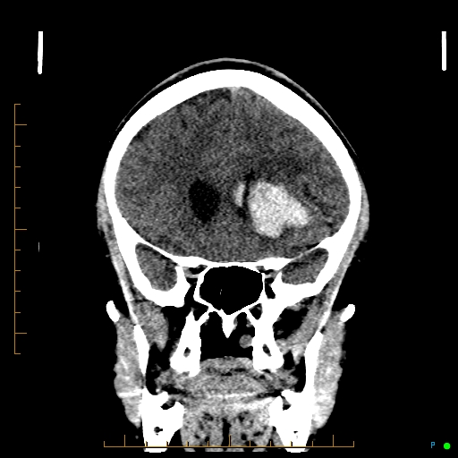 Cerebral arteriovenous malformation (AVM) (Radiopaedia 78162-90706 Coronal non-contrast 34).jpg