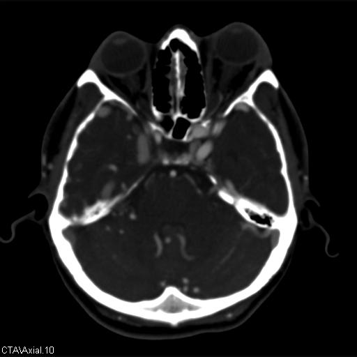 File:Cerebral arteriovenous malformation (Radiopaedia 28518-28759 B 10).jpg