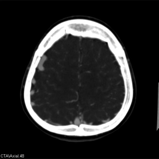 Cerebral arteriovenous malformation (Radiopaedia 28518-28759 B 48).jpg