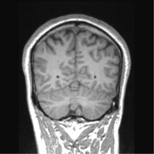 Cerebral arteriovenous malformation (Radiopaedia 39259-41506 Coronal T1 25).png