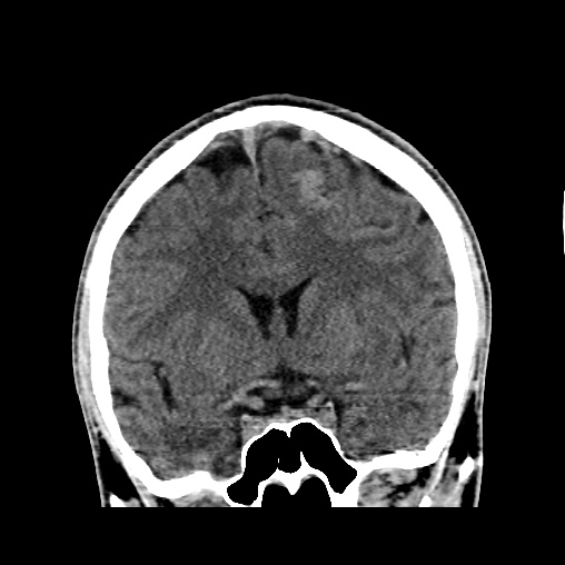Cerebral arteriovenous malformation (Radiopaedia 61964-70028 Coronal non-contrast 26).jpg