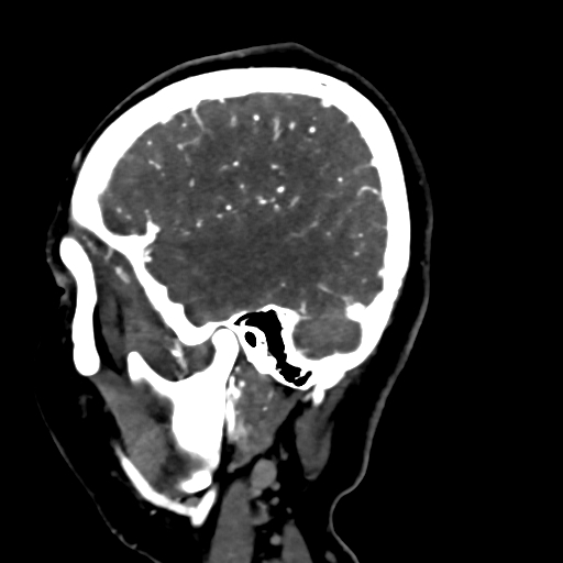 File:Cerebral arteriovenous malformation (Radiopaedia 73830-84645 Sagittal C+ delayed 75).jpg