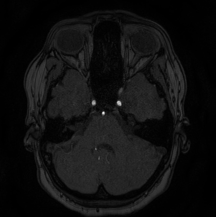 Cerebral arteriovenous malformation (Radiopaedia 74411-85654 Axial MRA 24).jpg