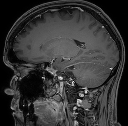 Cerebral arteriovenous malformation (Radiopaedia 74411-85654 Sagittal T1 C+ 50).jpg