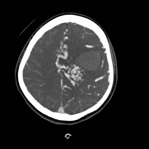File:Cerebral arteriovenous malformation (Radiopaedia 79677-92888 A 42).jpg