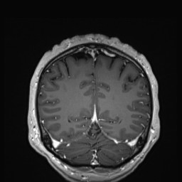 Cerebral arteriovenous malformation (Radiopaedia 84015-99245 Coronal T1 C+ 126).jpg