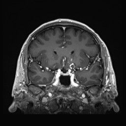 Cerebral arteriovenous malformation (Radiopaedia 84015-99245 Coronal T1 C+ 62).jpg