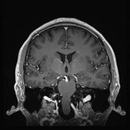 Cerebral arteriovenous malformation (Radiopaedia 84015-99245 Coronal T1 C+ 79).jpg