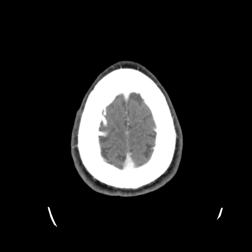 Cerebral arteriovenous malformation (Spetzler-Martin grade 2) (Radiopaedia 41262-44076 Axial C+ 47).png