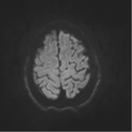 File:Cerebral arteriovenous malformation - huge (Radiopaedia 35734-37272 Axial DWI 43).png