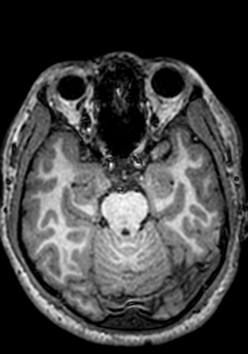 Cerebral arteriovenous malformation at posterior body of corpus callosum (Radiopaedia 74111-84925 Axial T1 203).jpg