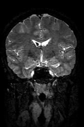 Cerebral arteriovenous malformation at posterior body of corpus callosum (Radiopaedia 74111-84925 Coronal T2 80).jpg