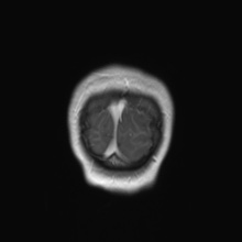 File:Cerebral cavernous venous malformation (Radiopaedia 70008-80021 Coronal T1 C+ 4).jpg