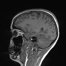 File:Cerebral cavernous venous malformation (Radiopaedia 70008-80021 Sagittal T1 50).jpg