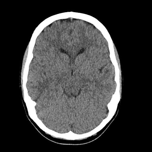 Cerebral cavernous venous malformation (Radiopaedia 70008-80022 Axial non-contrast 20).jpg