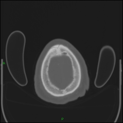 Cerebral contusions (Radiopaedia 33868-35039 Axial bone window 209).jpg