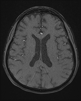 Cerebral embolic infarcts (embolic shower) (Radiopaedia 72391-82921 Axial MRA 117).jpg