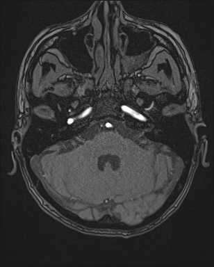 Cerebral embolic infarcts (embolic shower) (Radiopaedia 72391-82921 Axial MRA 22).jpg
