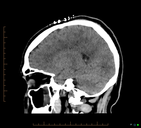 Cerebral fat embolism (Radiopaedia 85521-101220 B 21).jpg