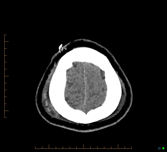 Cerebral fat embolism (Radiopaedia 85521-101224 Axial non-contrast 47).jpg