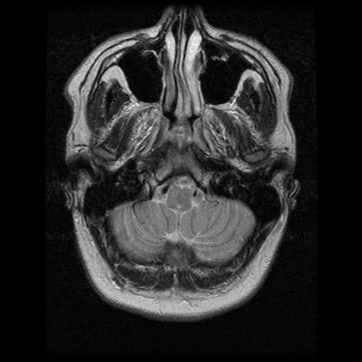 File:Cerebral hemorrhage secondary to arteriovenous malformation (Radiopaedia 33497-34572 Axial T2 4).png