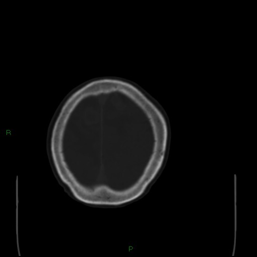 Cerebral metastases - breast primary (Radiopaedia 77653-89857 Axial bone window 102).jpg