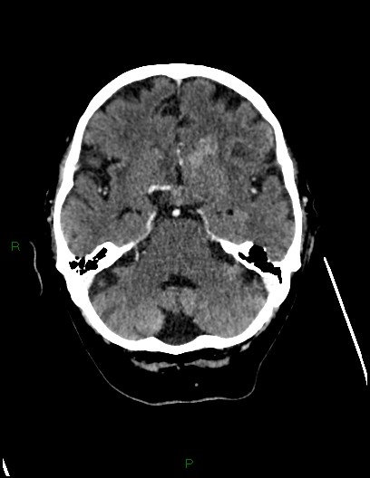 Cerebral metastases - ependymal and parenchymal (Radiopaedia 79877-93131 Axial C+ delayed 25).jpg