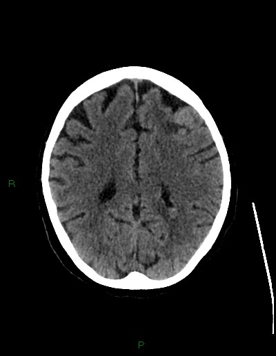 File:Cerebral metastases - ependymal and parenchymal (Radiopaedia 79877-93131 Axial non-contrast 52).jpg