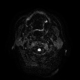 File:Cerebral metastases - melanoma (Radiopaedia 80972-94522 Axial DWI 1).jpg