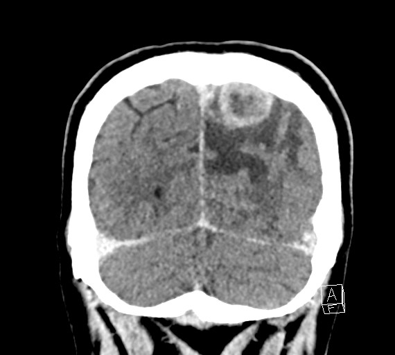 Cerebral metastases - testicular choriocarcinoma (Radiopaedia 84486-99855 D 52).jpg