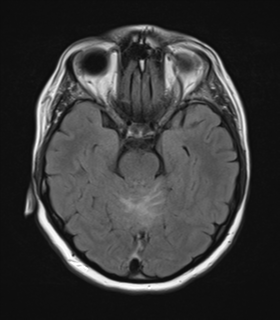 File:Cerebral metastases mimicking abscesses (Radiopaedia 45841-50131 Axial FLAIR 11).png