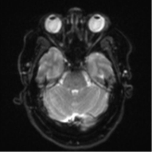 Cerebral metastases mimicking multifocal glioblastoma (Radiopaedia 50843-56353 Axial DWI 8).png