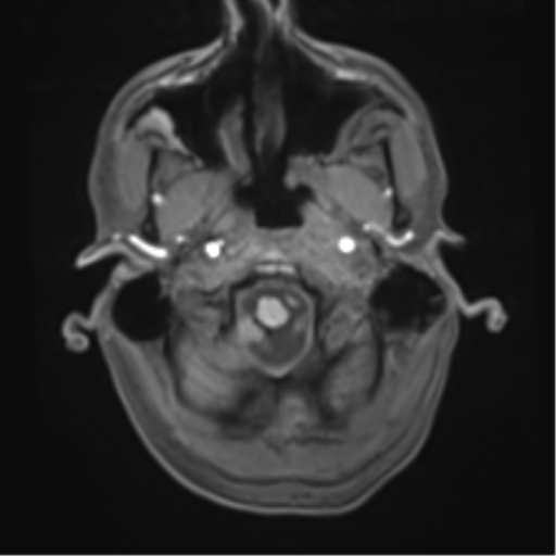 Cerebral metastasis - melanoma (Radiopaedia 54718-60954 Axial T1 7).png