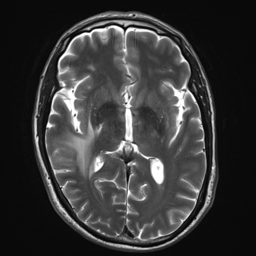 File:Cerebral metastasis - melanoma (Radiopaedia 54718-60954 Axial T2 15).png